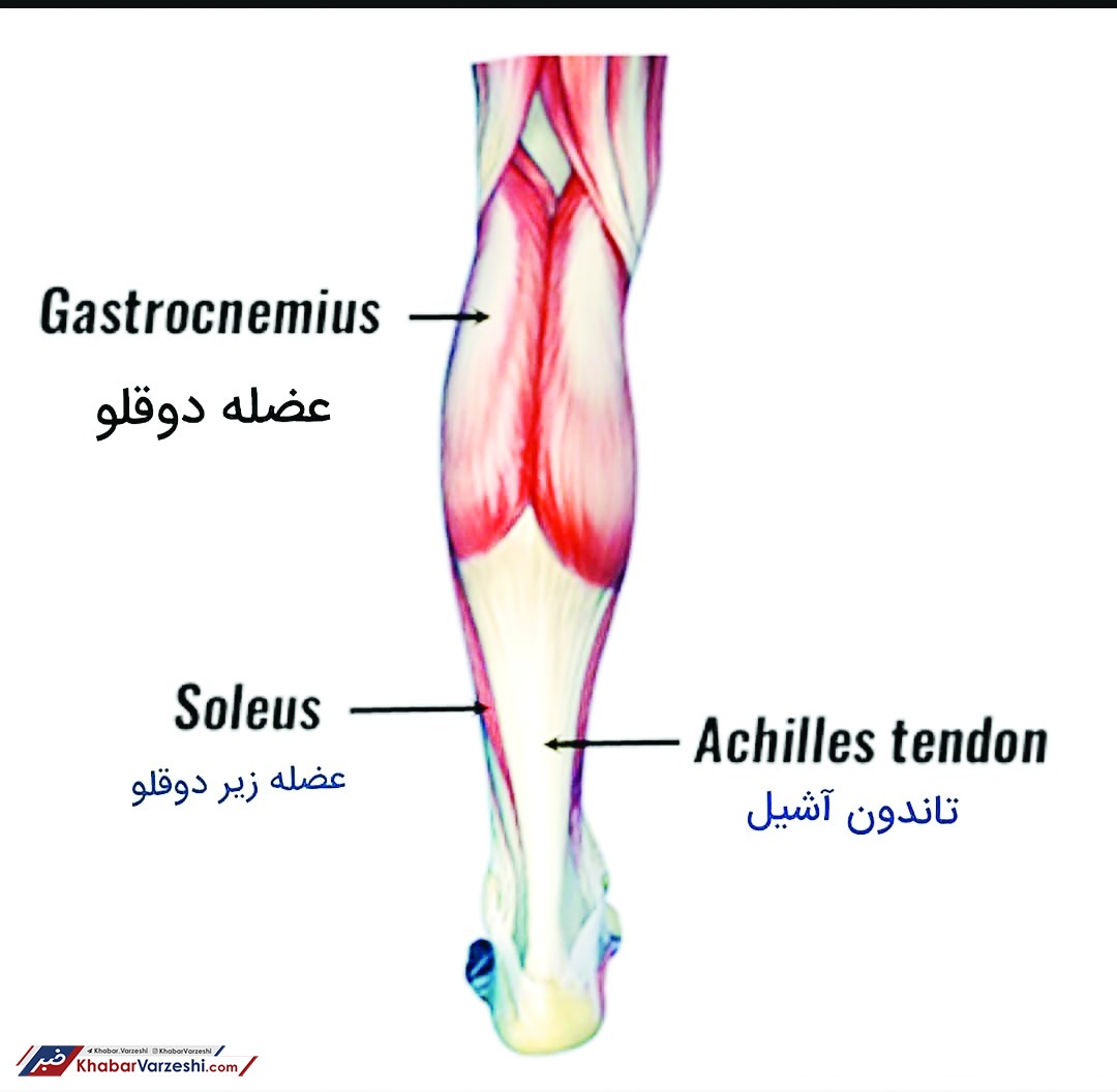 آسیب ورزشی| پارگی عضله دوقلوی ساق در ورزشکاران